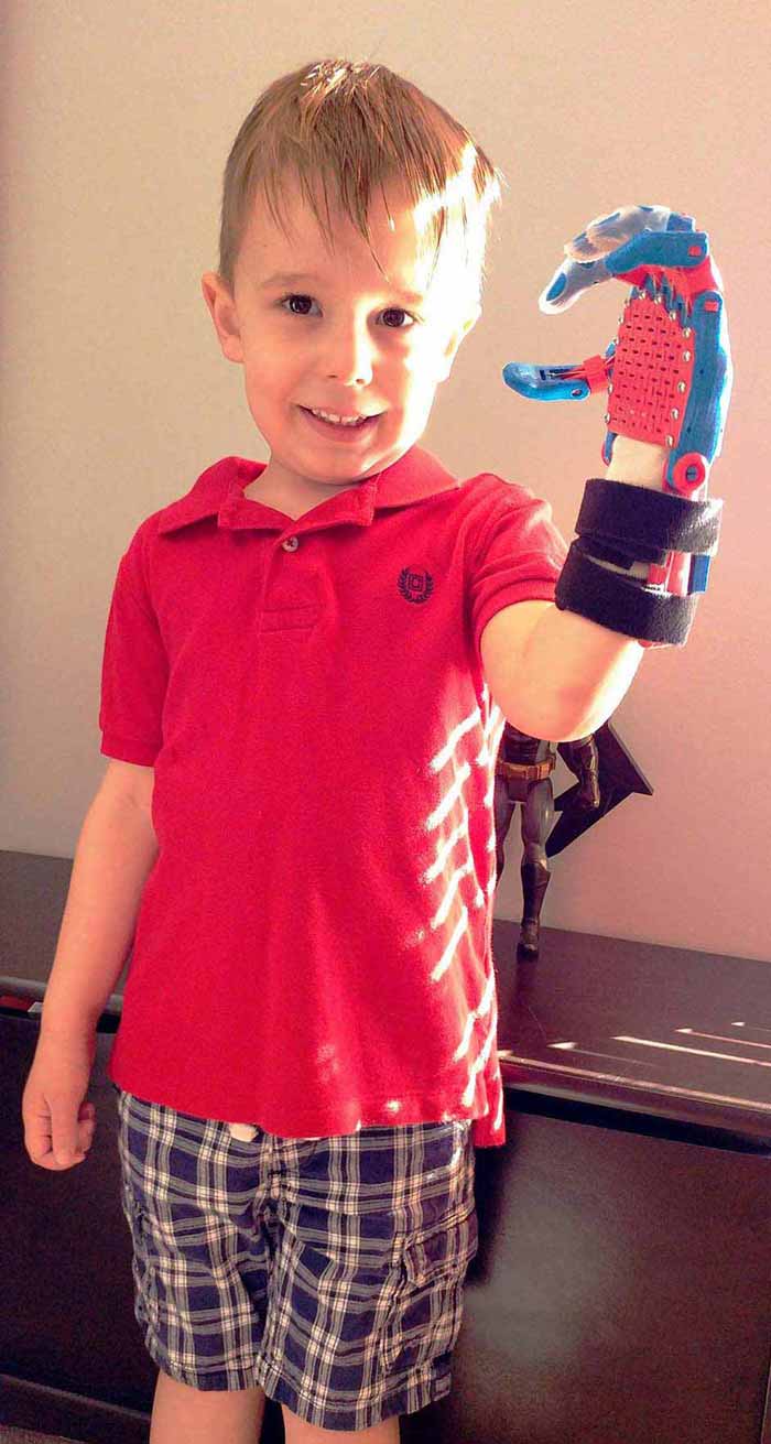 Owen Lewis smiling and showing his prosthetic hand