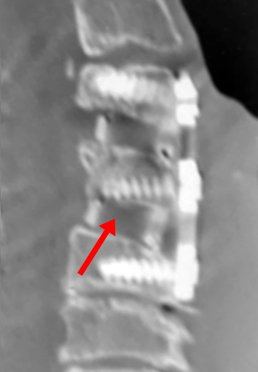 Lateral X-ray view of a spinal fusion with screws and rods.