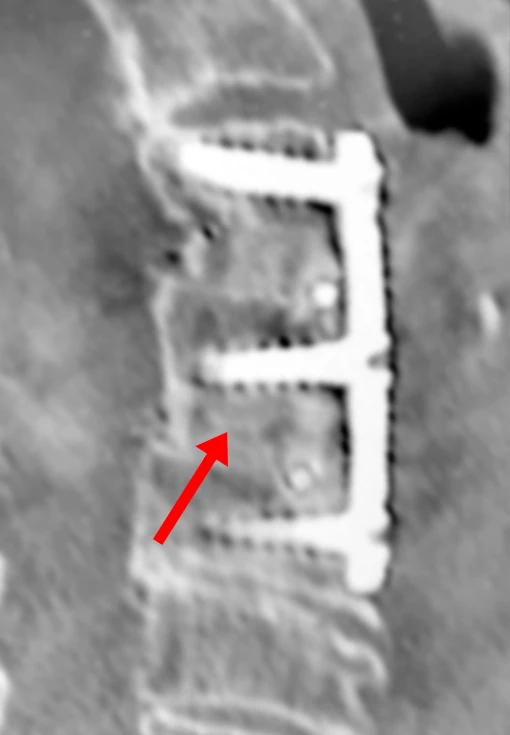Grayscale medical scan showing two implanted metal plates and screws in a spinal fusion.