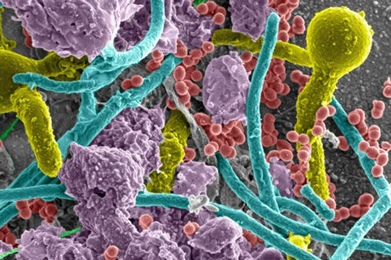 A zoomed in, microscopic image of a polymicrobial infection in a catheterized bladder showing the colors gold, teal, red, purple and green.